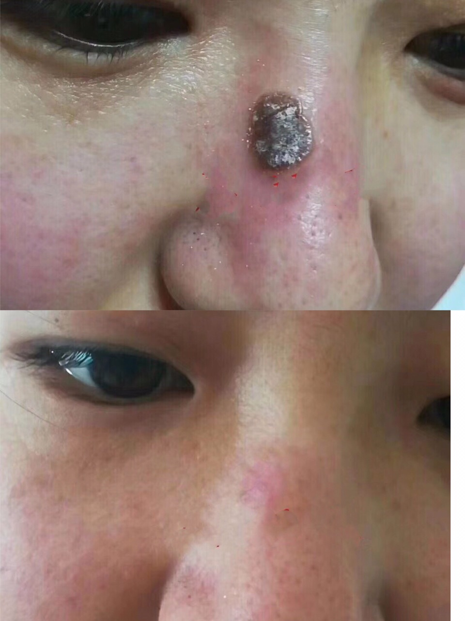三种易病变的痣,你可能经常碰到它,但未必识破它