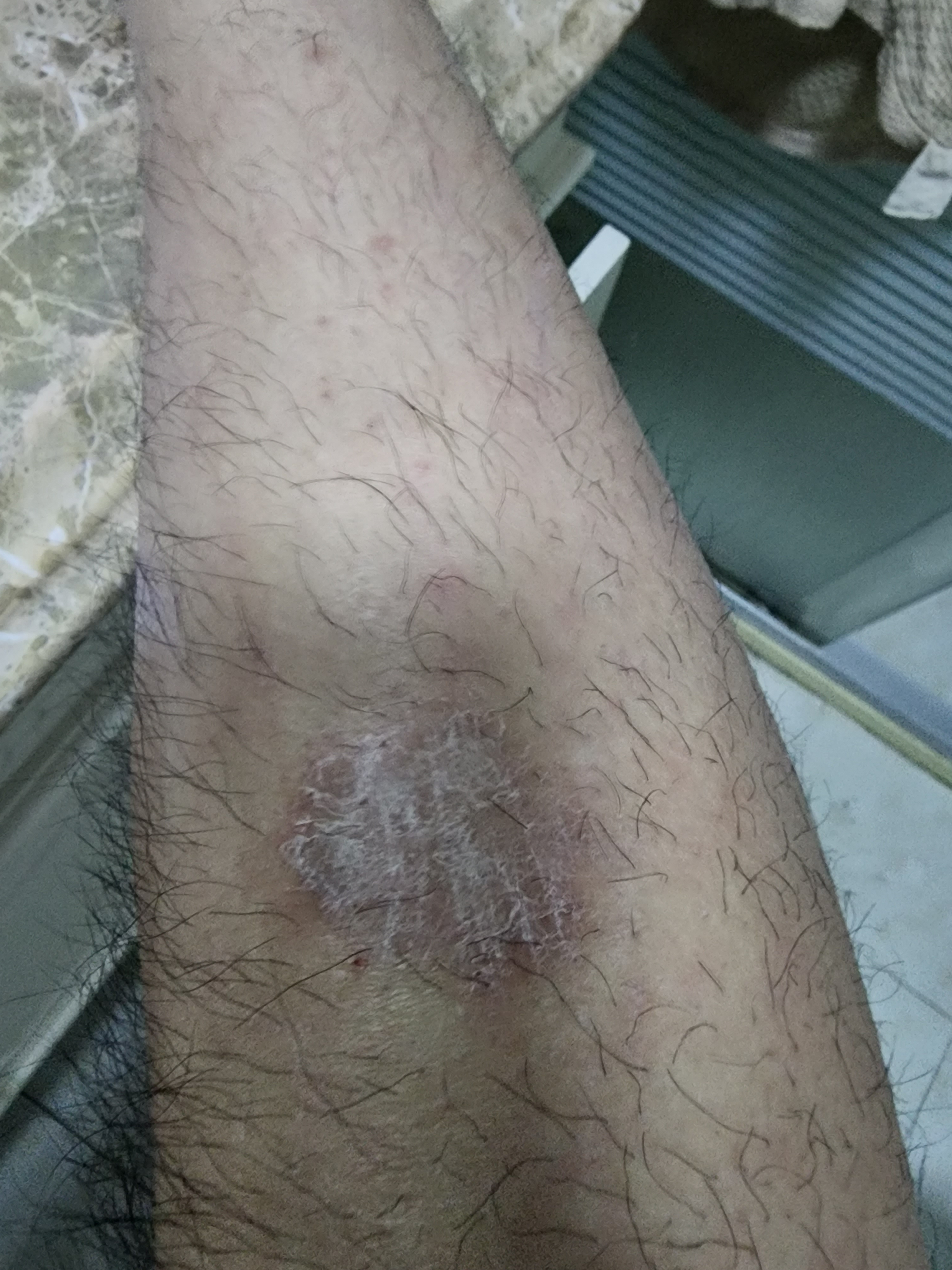 常州哪个医院看皮肤病好,身上不疼不痒,挠了之后就这样发白|龙城茶座